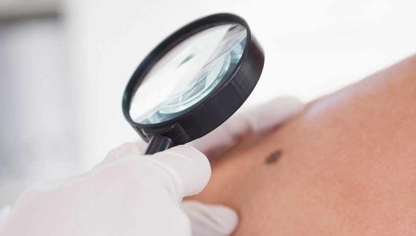 A gloved hand holds a magnifying glass over a mole on a person's skin for close examination, as a dermatologist assesses potential concerns—a scenario often explored in MCCQE1 exam prep.